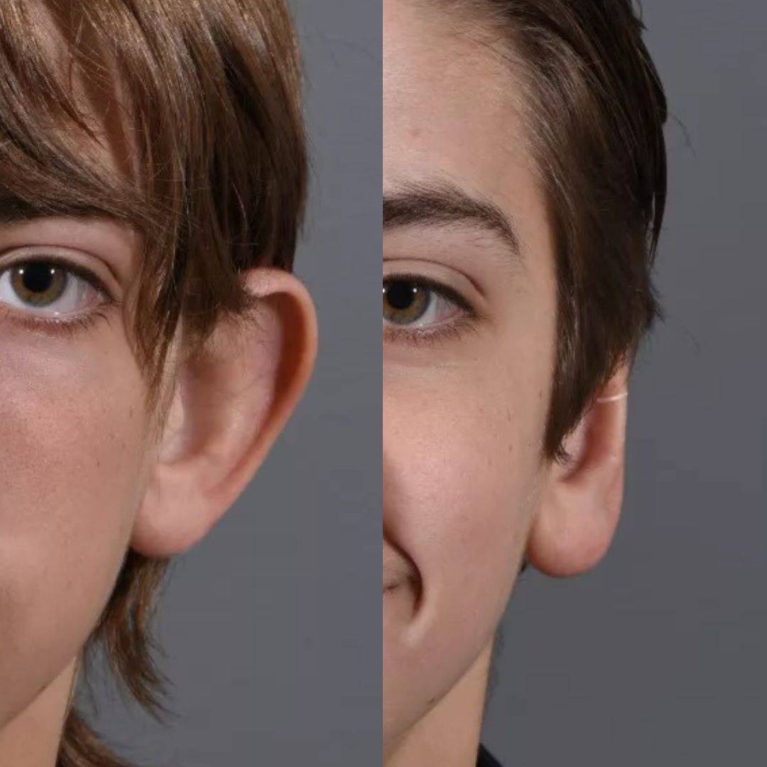 Pince correctrice d'oreilles