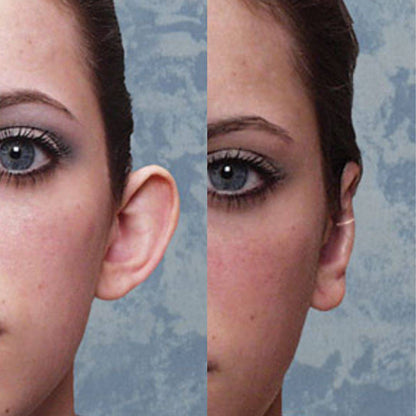 Pince correctrice d'oreilles